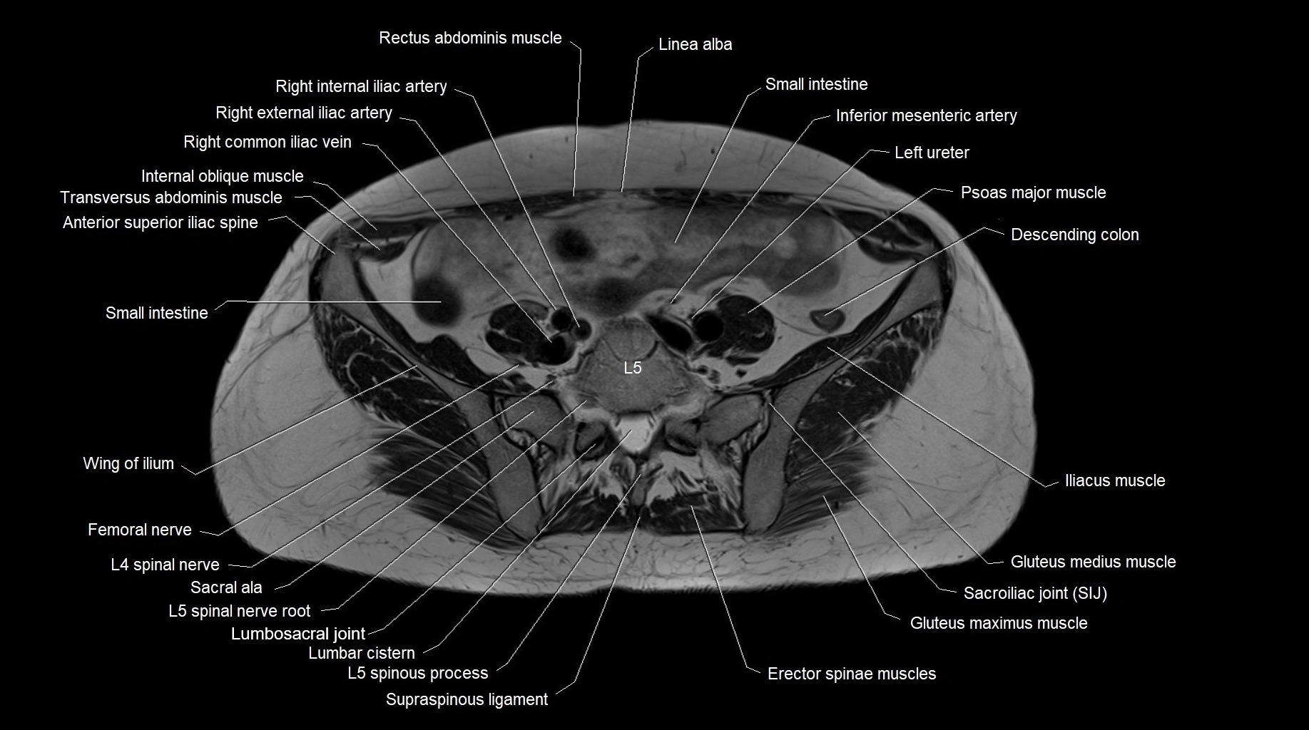 MRI 3T pelvis axial cross section anatomy image 7.webp